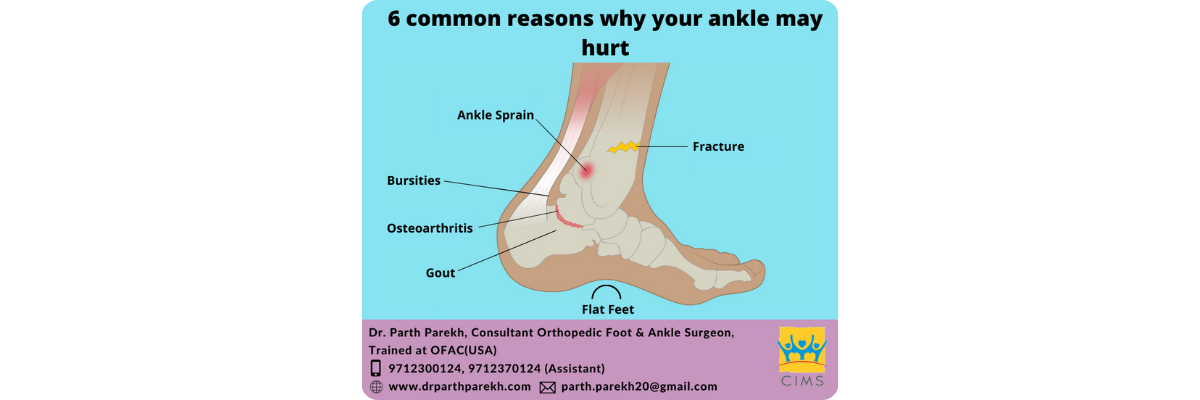 6 common reasons why your ankle may hurt - Dr. Parth Parekh