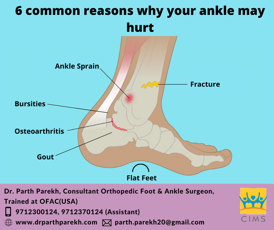 6 common reasons why your ankle may hurt - Dr. Parth Parekh