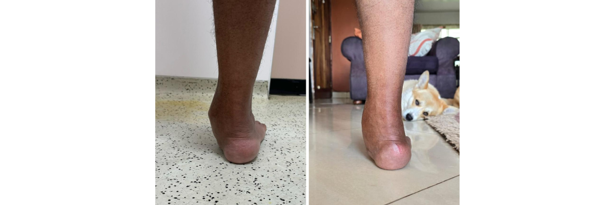 Sarita Iyer (Karnataka) 58year - Dr. Parth Parekh