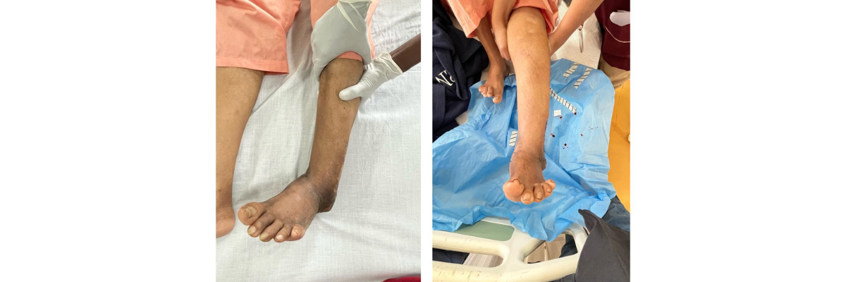 Perna Dixit (Indore) 68 year - Dr. Parth Parekh