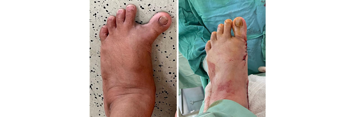 Hallux varus (Pratima Bundhopadyay, Bengal) - Dr. Parth Parekh