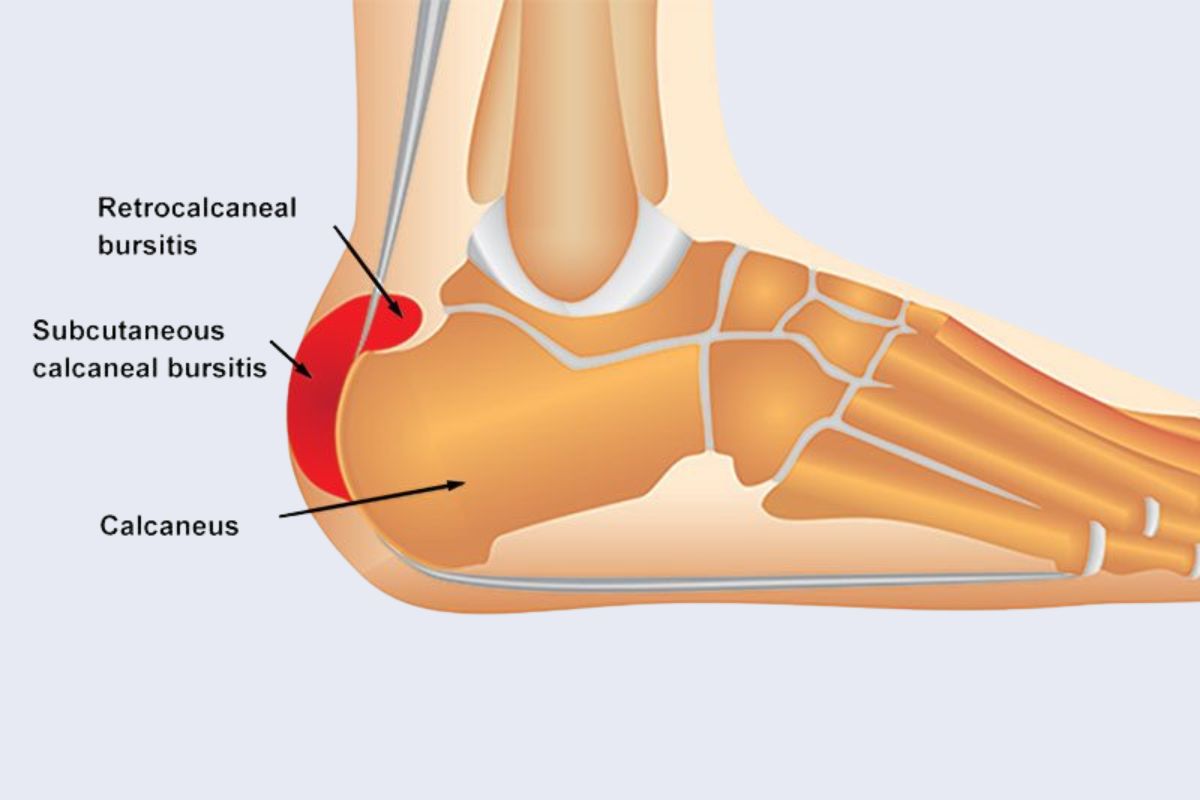 Retro-calceneal Bursitis - Dr. Parth Parekh